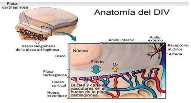 Hernia discal - Imagen 2