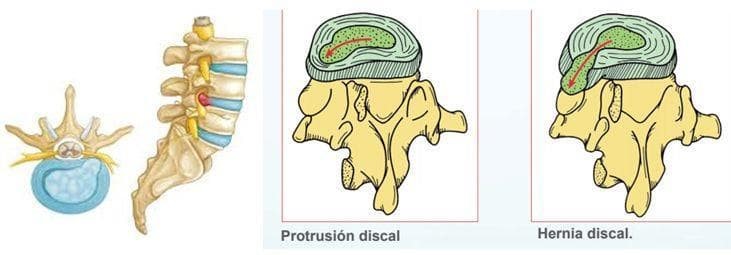 Hernia discal - Imagen 1